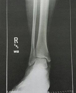Ankle